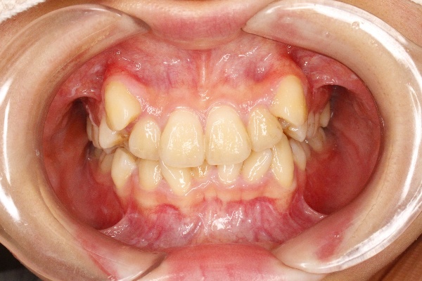歯科医師会田の噛み合わせメディア〜カムシル〜｜重度の八重歯でもマウスピース矯正で治した治療例｜治療前の歯の画像