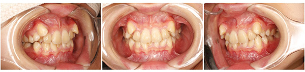 歯科医師会田の噛み合わせメディア〜カムシル〜｜重度の八重歯でもマウスピース矯正で治した治療例｜治療前の歯の画像