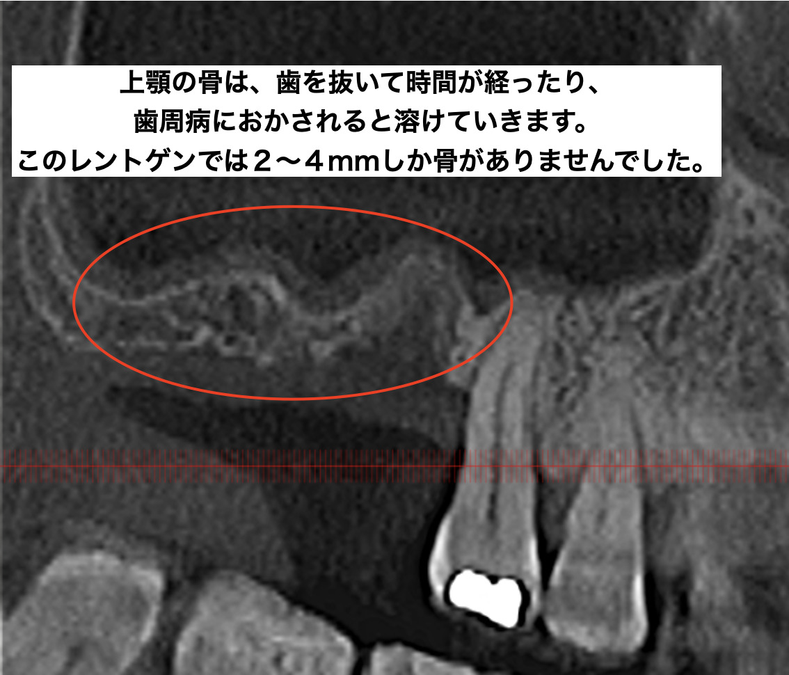 少ない骨の部分に長いインプラントをすると問題が起きる