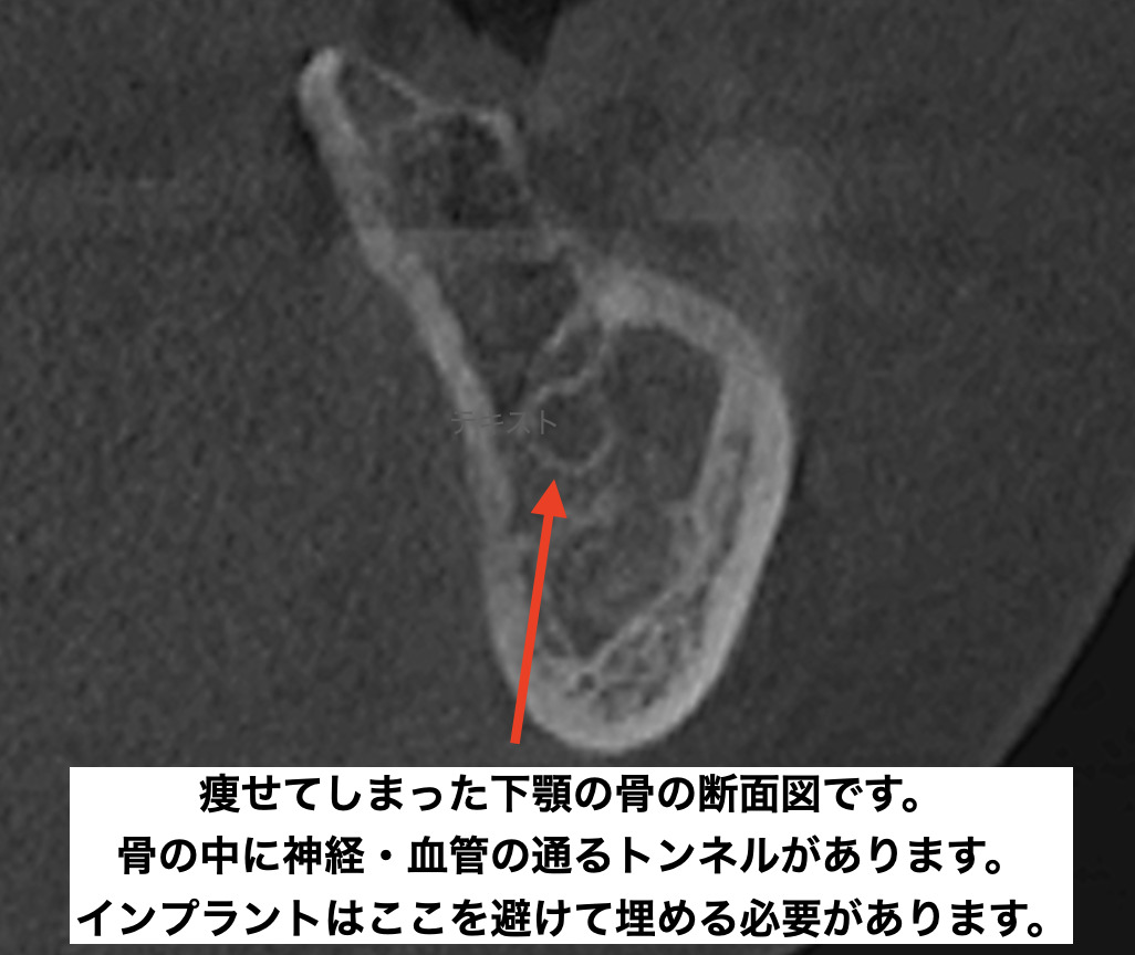 痩せてしまった下顎の骨の断面図