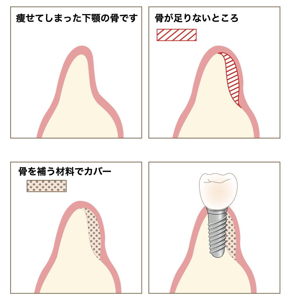 インプラント。骨をカバーする