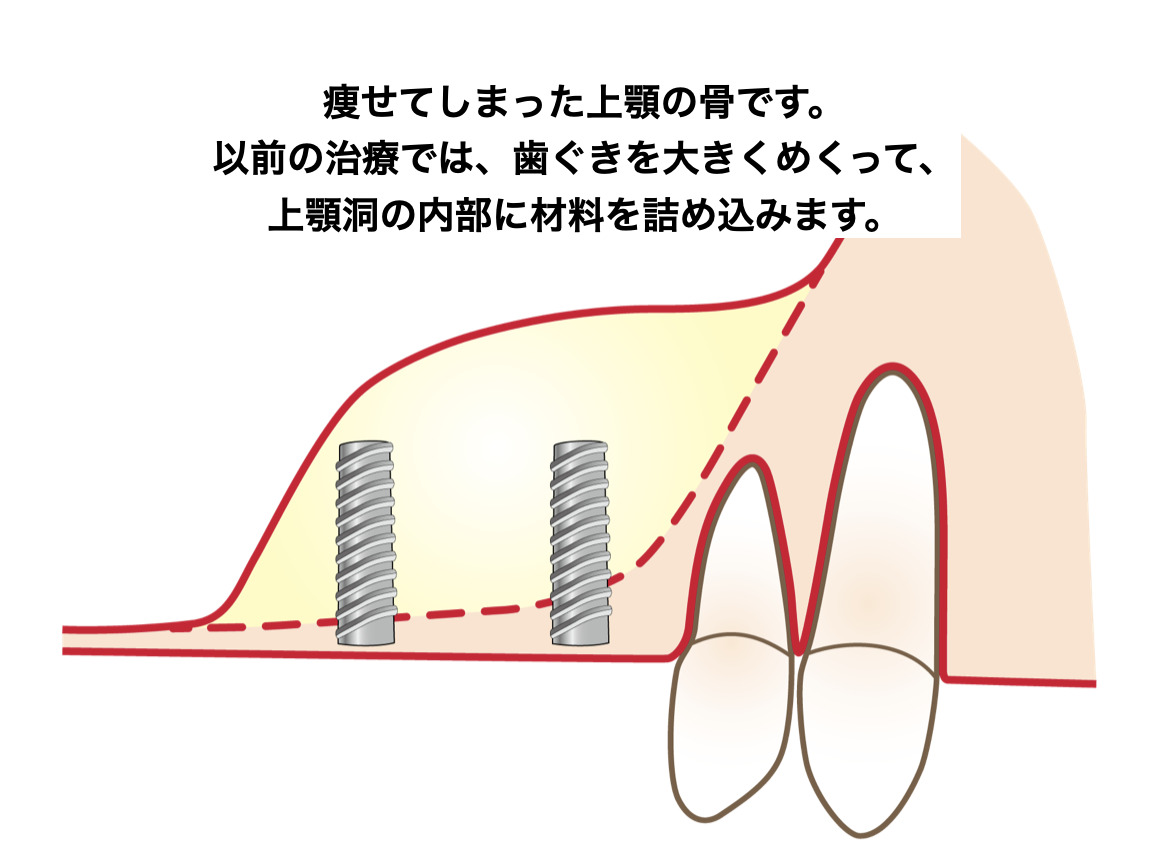 痩せた骨にインプラントをする方法