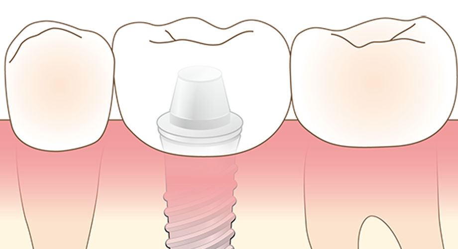 顎の骨が少ない？！インプラント治療に迷っている方へ