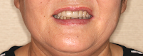 過蓋咬合（ディープバイト）の治療例と予防法｜治療後2